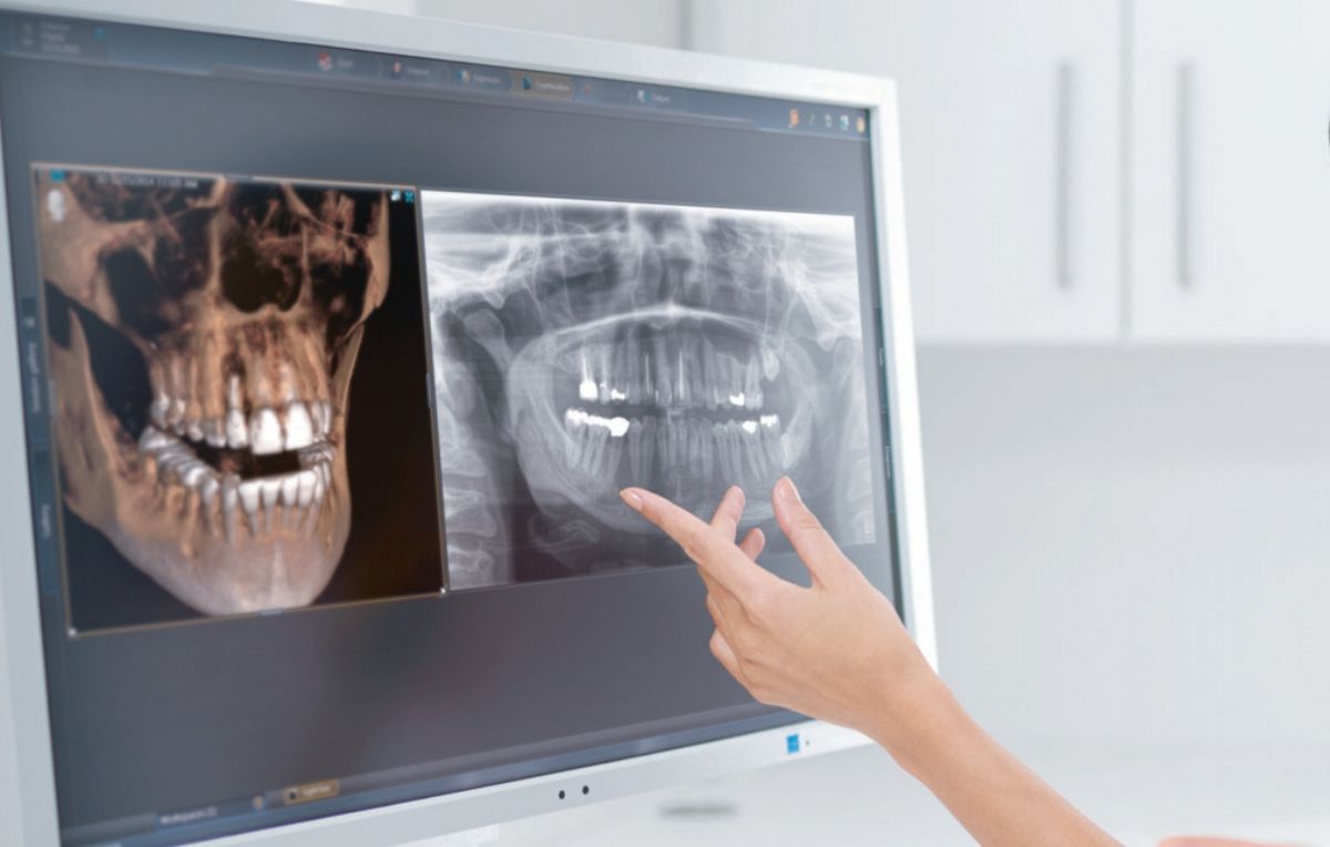 Компьютерная томография челюсти снимок зубов