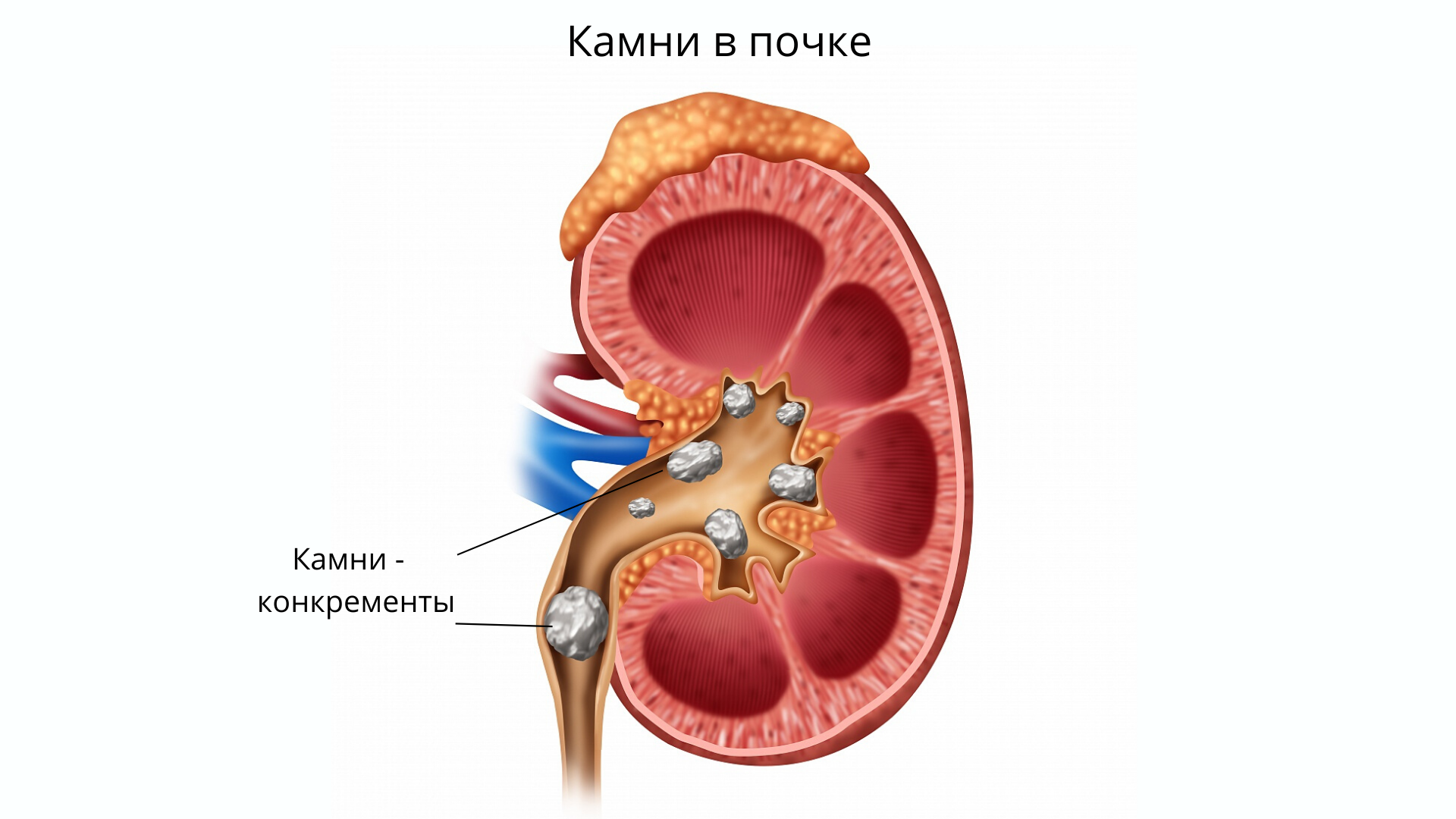 Мочекаменная болезнь почек. Мочекаменная болезнь камни. Мочекаменная болезнь (нефролитиаз).