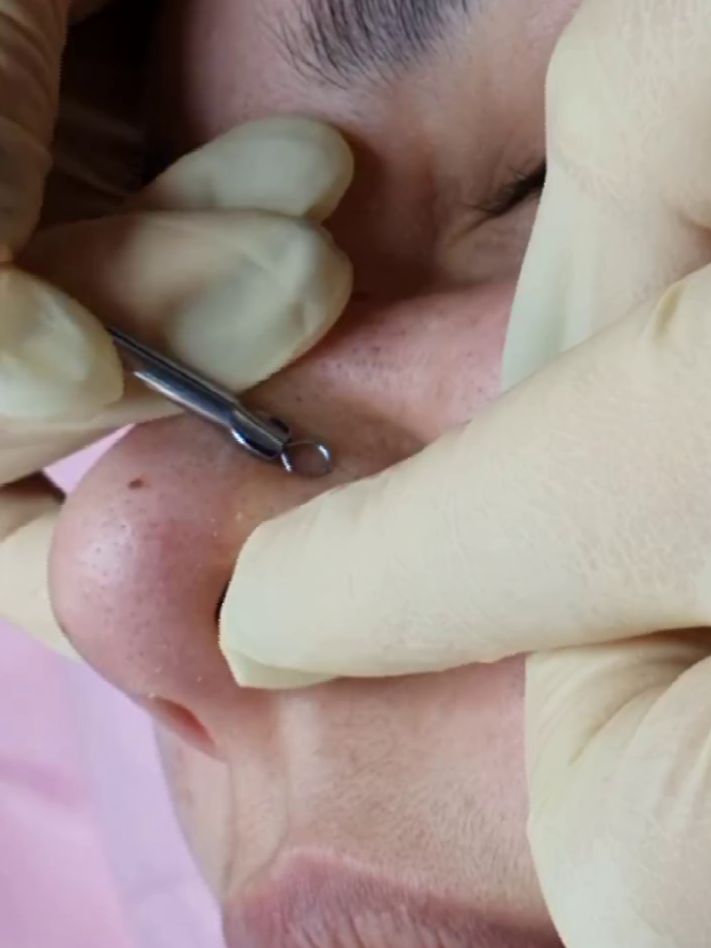 Процесс механической чистки лица с помощью ложки "УНО"