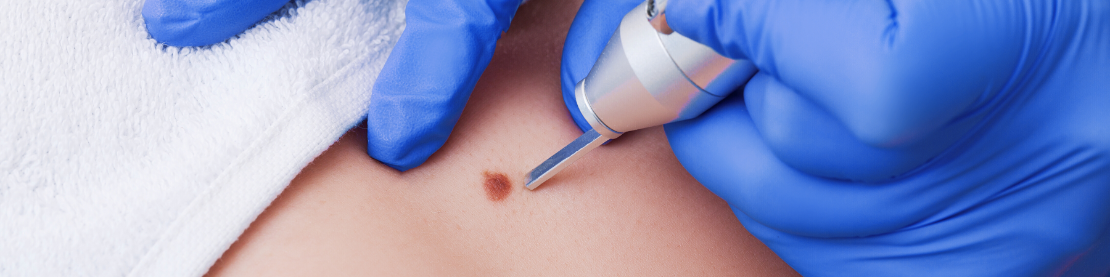 Криомассаж