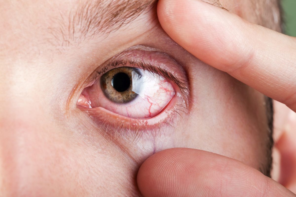 Воспаление роговицы глаза: симптомы и лечение