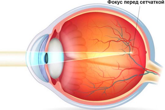 Глаз при близорукости и дальнозоркости картинки