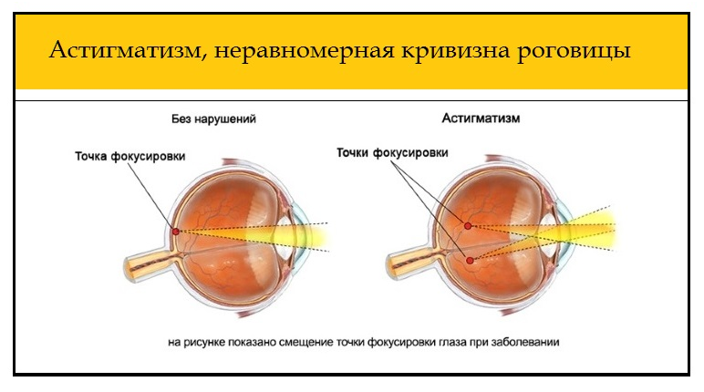 Нормальное зрение. Строение глаза человека астигматизм. Болезни глаз дальнозоркость близорукость. Миопия гиперметропия астигматизм. Заболевание органов зрения миопия.