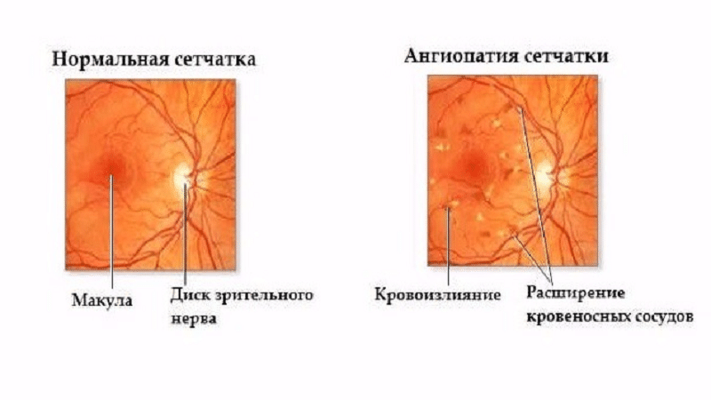 Сетчатки обоих глаз. Ангиопатии сосудов сетчатки. Гипертоническая ангиопатия сетчатки. Ангиопатия сетчатки глазное дно. .Ангиопатия сетчатки,экзофория.