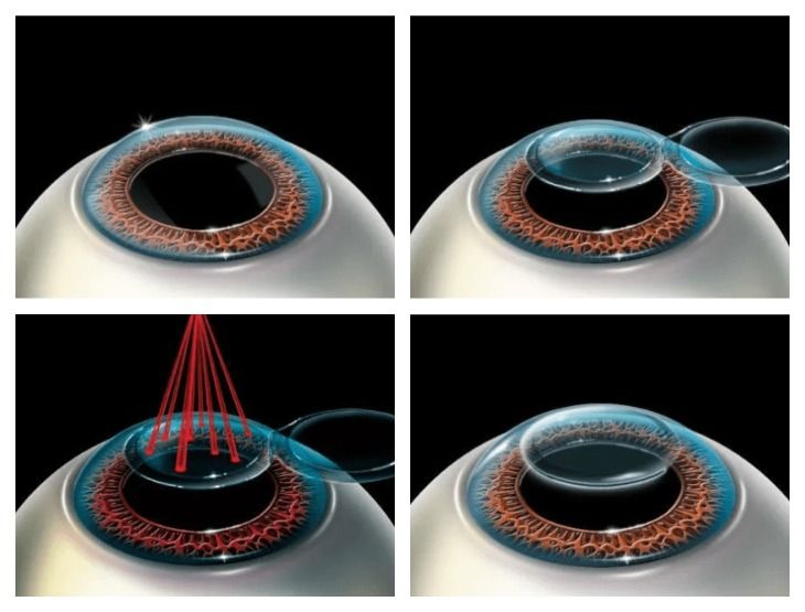 Повторная лазерная коррекция зрения. LASIK лазерный кератомилез. Капли после лазерной коррекции зрения ласик. Коррекция зрения с помощью LASIK лазерный кератомилез.