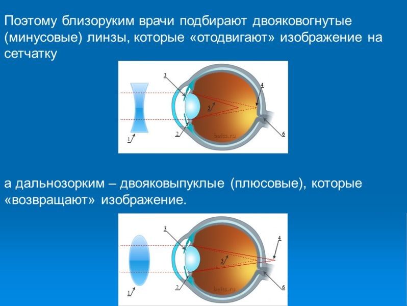 Глаз очки дальнозоркость и близорукость. Линзы двояковыпуклые близорукость и дальнозоркость. Двояковогнутая линза. Двояковогнутая линза для близорукости. Двояковыпуклая линза для дальнозоркости.