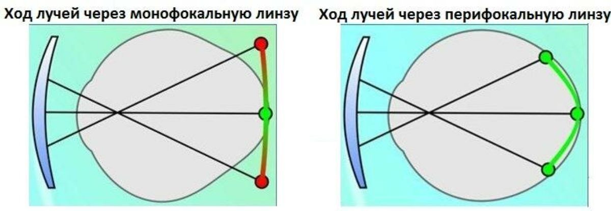 Перифокальные линзы. Линзы Перифокалы. Разметка перифокальной линзы. Линзы для остановки миопии. Строение перифокальные линзы.