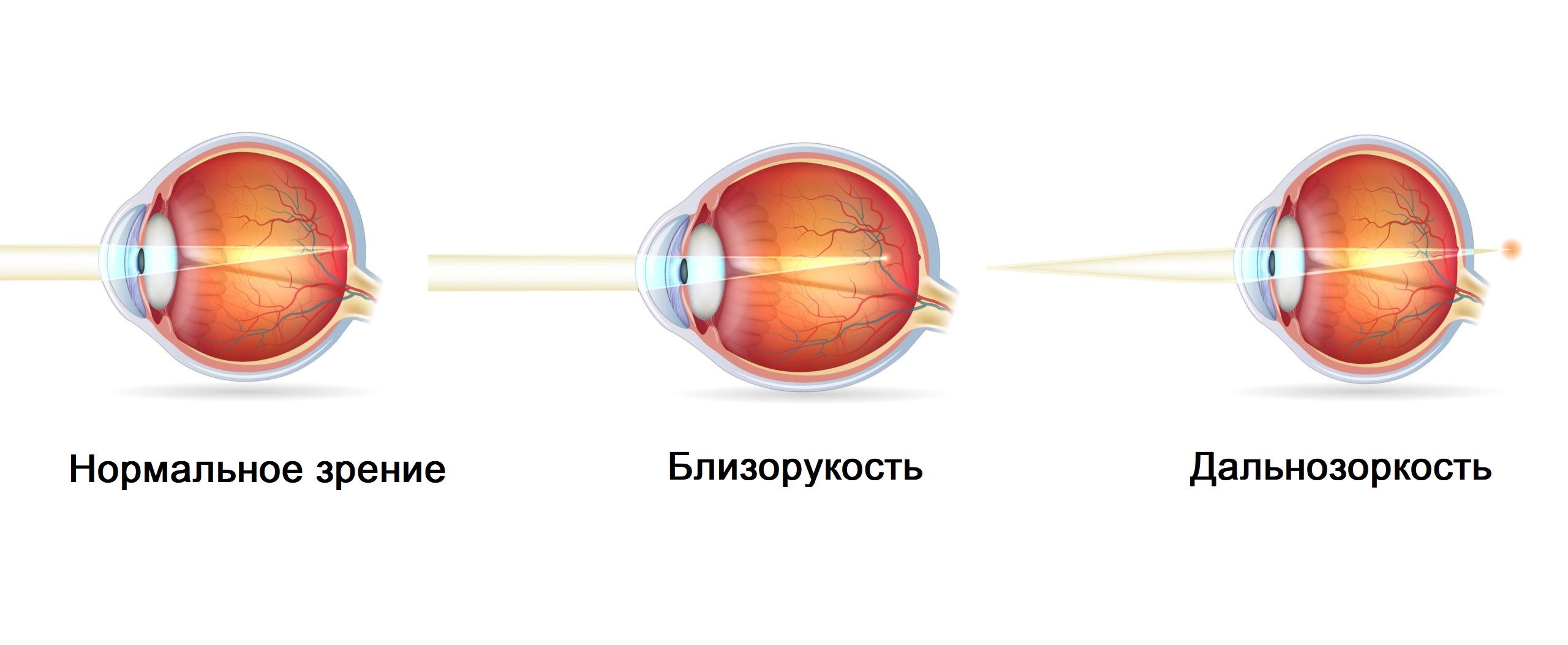 Нормальное зрение близорукость дальнозоркость