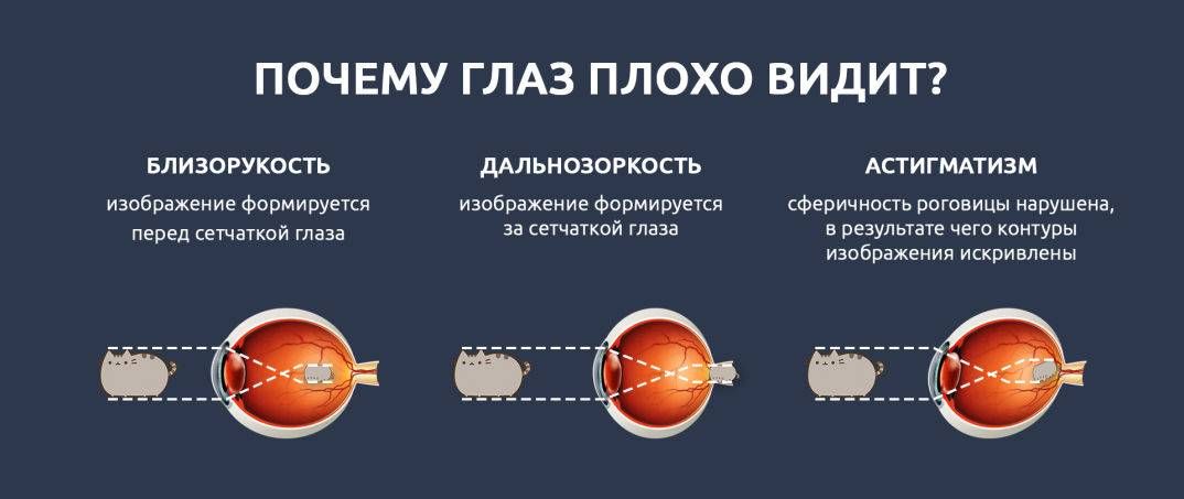 Рассмотрите рисунок сравните близорукость и дальнозоркость ответы занесите в таблицу