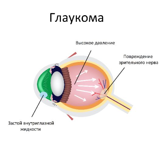 Глаукома схема