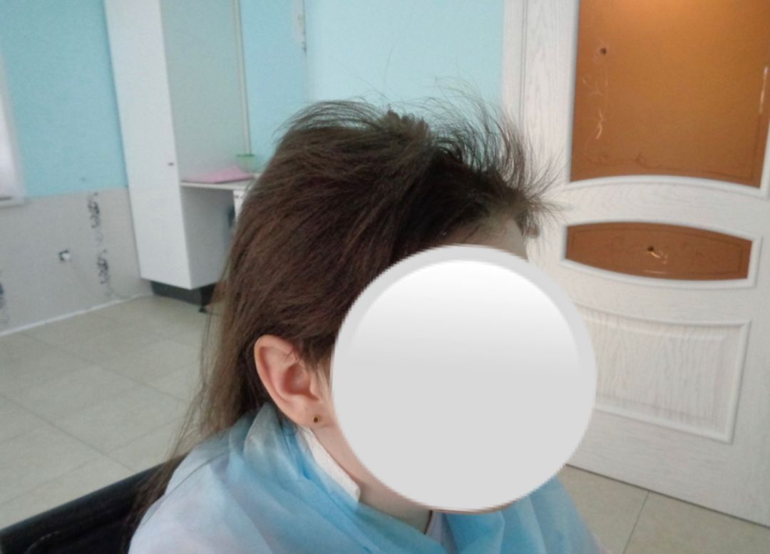 рост волос в результате применения Мивала