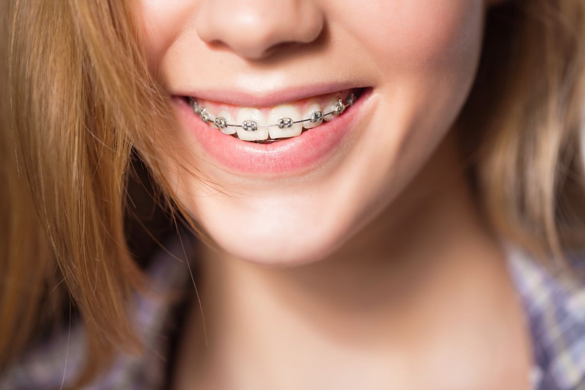 Поставить брекеты в Москве - цены на услуги DentalOpera