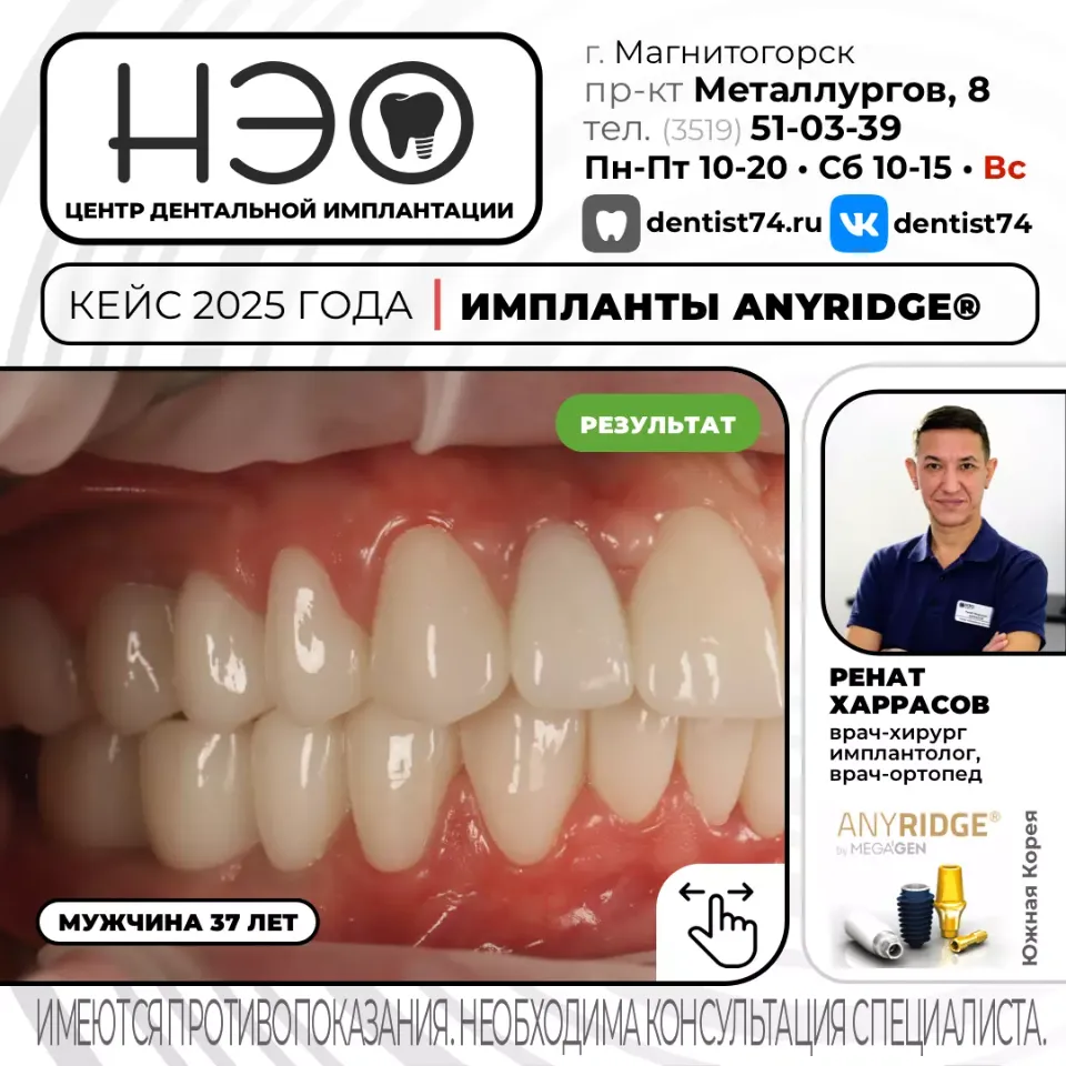 КЕЙС №03/2025 ИМПЛАНТАЦИЯ ЗУБОВ НА ИМПЛАНТАХ ANYRIDGE (Ю.Корея) В МАГНИТОГОРСКЕ. 