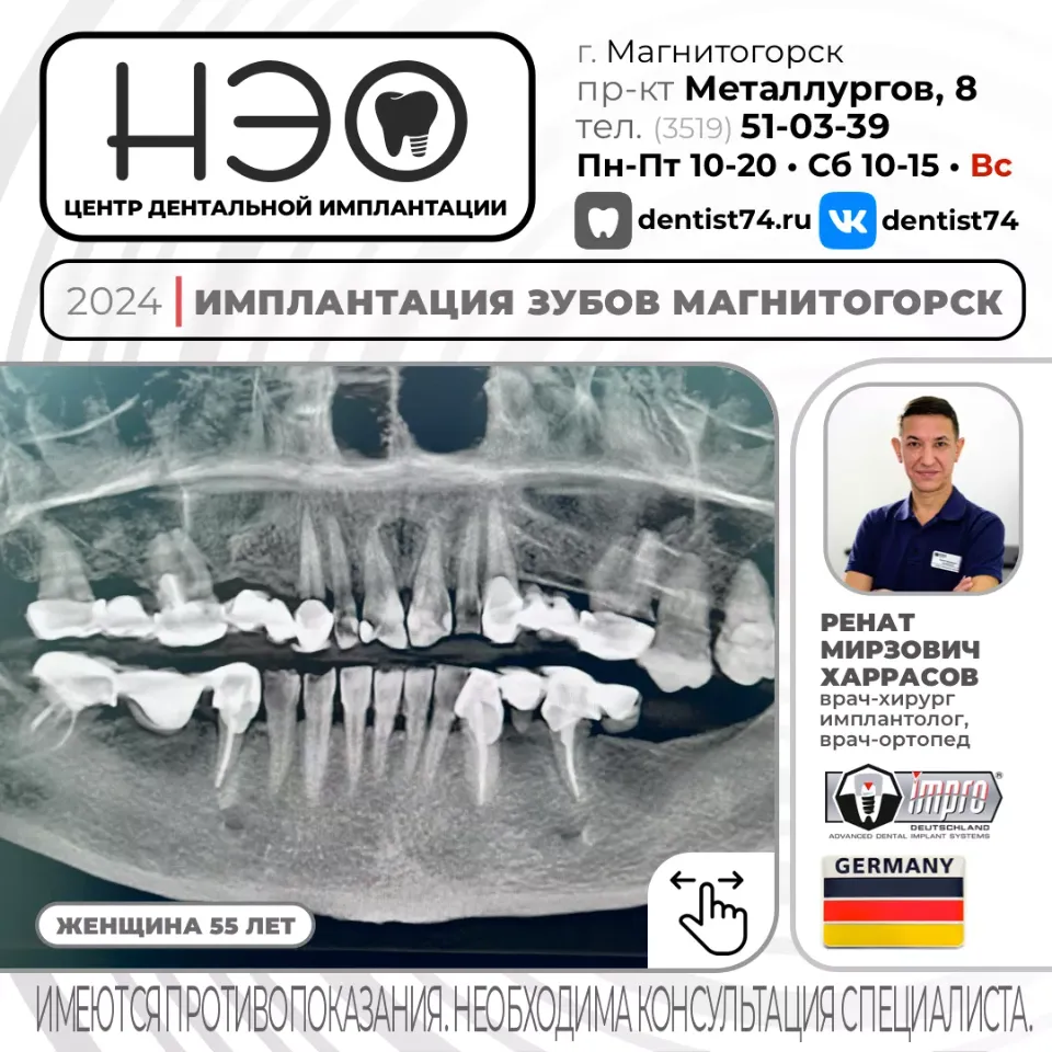 КЕЙС №01/2024 ИМПЛАНТАЦИЯ ЗУБОВ НА ИМПЛАНТАХ IMPRO (ГЕРМАНИЯ) В МАГНИТОГОРСКЕ.