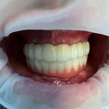 ИМПЛАНТАЦИЯ ПО СИСТЕМЕ ALL-ON-4 В МАГНИТОГОРСКЕ