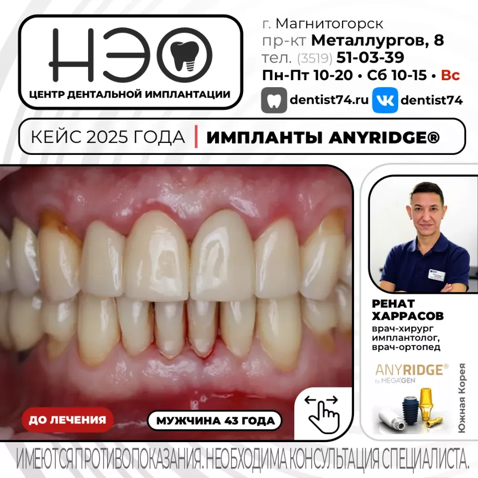 Работы доктора Харрасова Р.М. имплантация зубов в Магнитогорске
