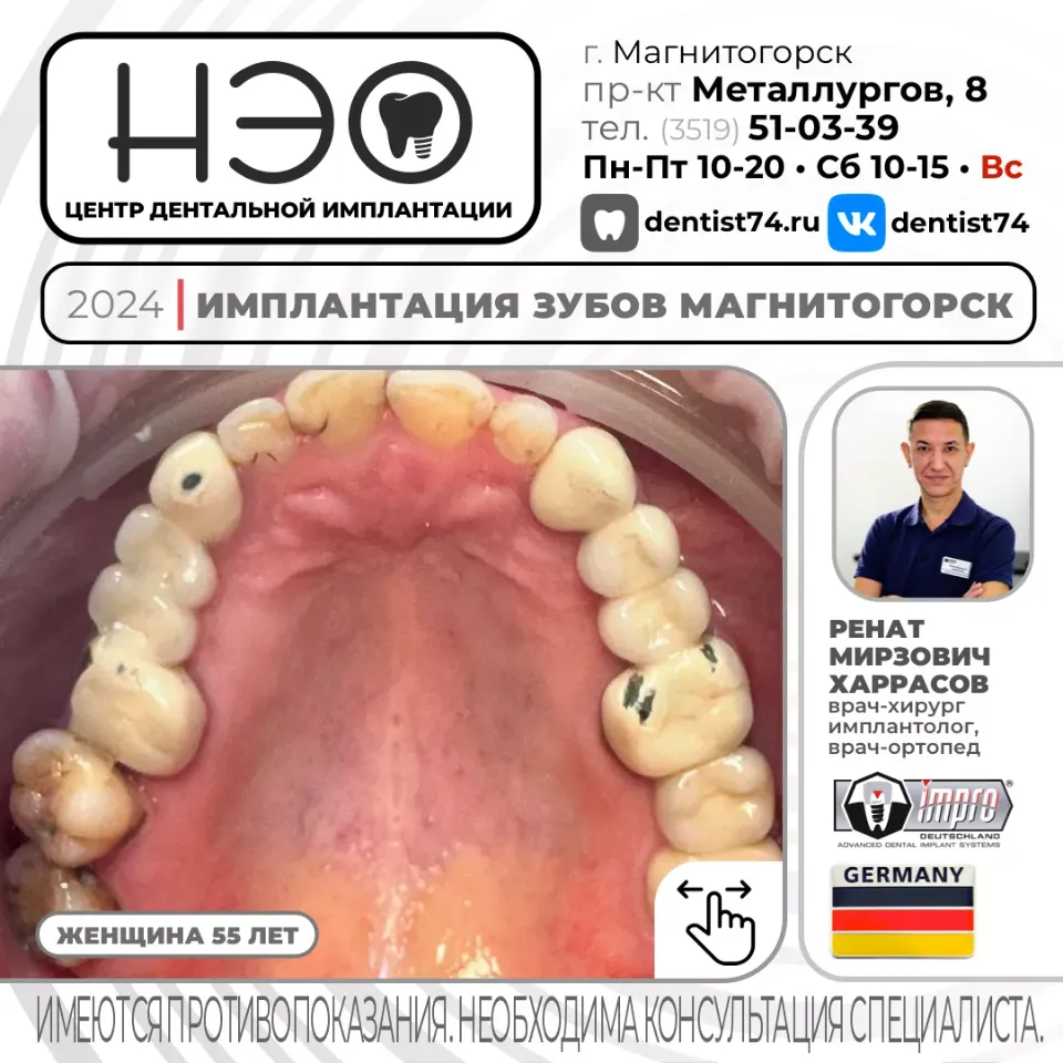 КЕЙС №01/2024 ИМПЛАНТАЦИЯ ЗУБОВ НА ИМПЛАНТАХ IMPRO (ГЕРМАНИЯ) В МАГНИТОГОРСКЕ.