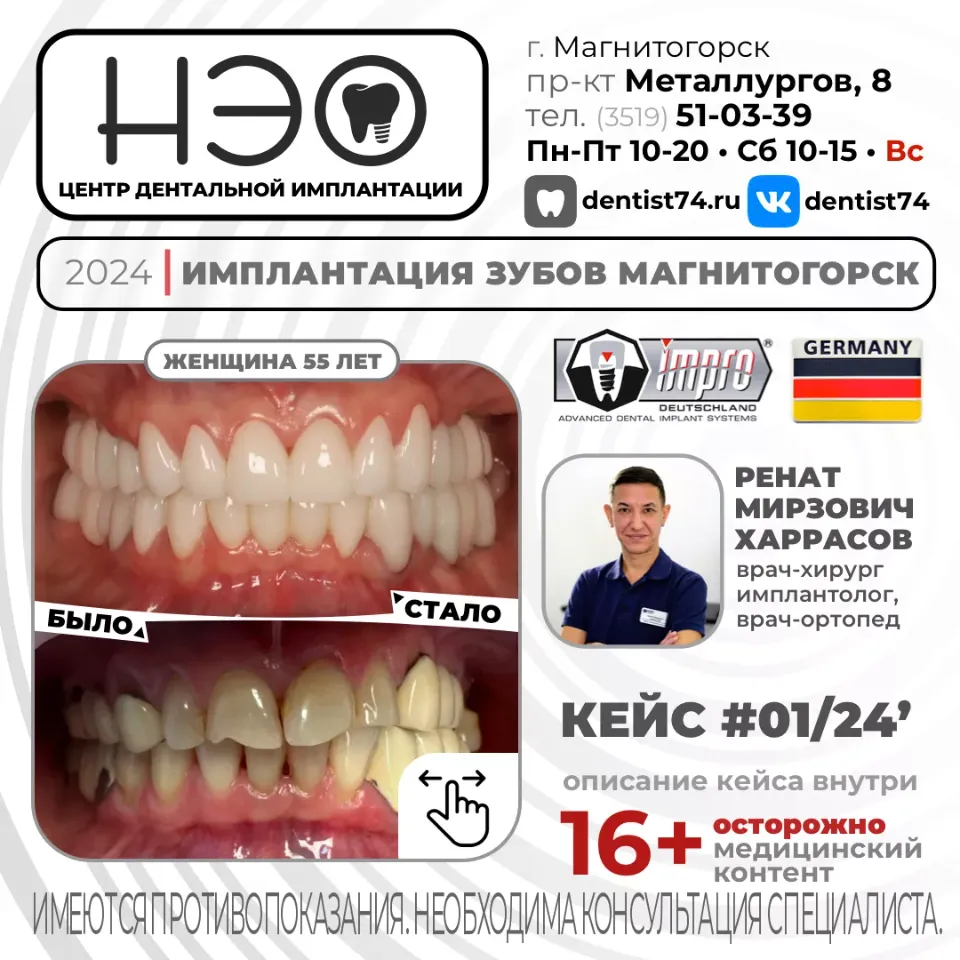 КЕЙС №01/2024 ИМПЛАНТАЦИЯ ЗУБОВ НА ИМПЛАНТАХ IMPRO (ГЕРМАНИЯ) В МАГНИТОГОРСКЕ.