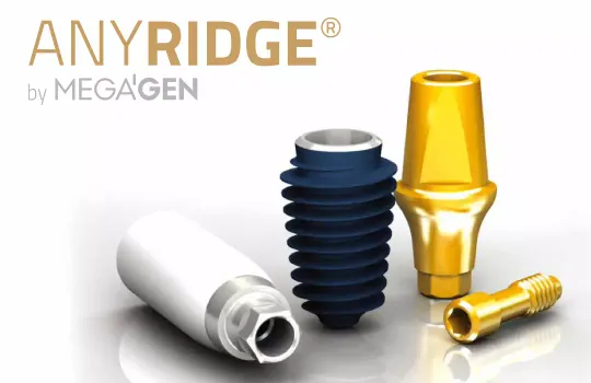 Установка одного имплантата AnyRidge (Южная Корея) со стоимостью импланта от 35000 рублей в Магнитогорске