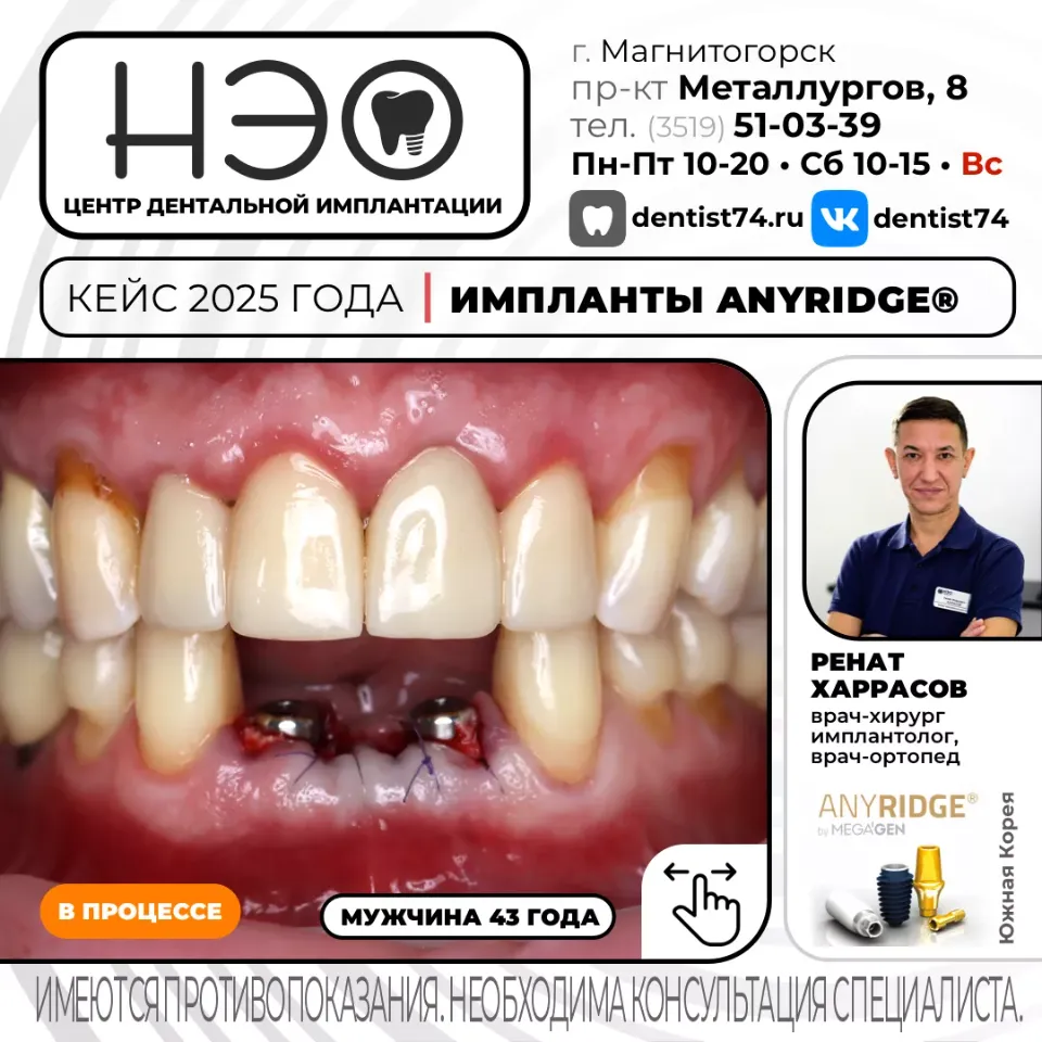 Работы доктора Харрасова Р.М. имплантация зубов в Магнитогорске