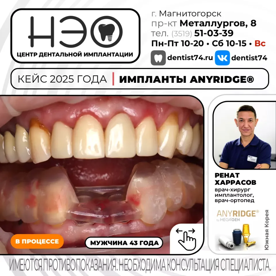 Работы доктора Харрасова Р.М. имплантация зубов в Магнитогорске
