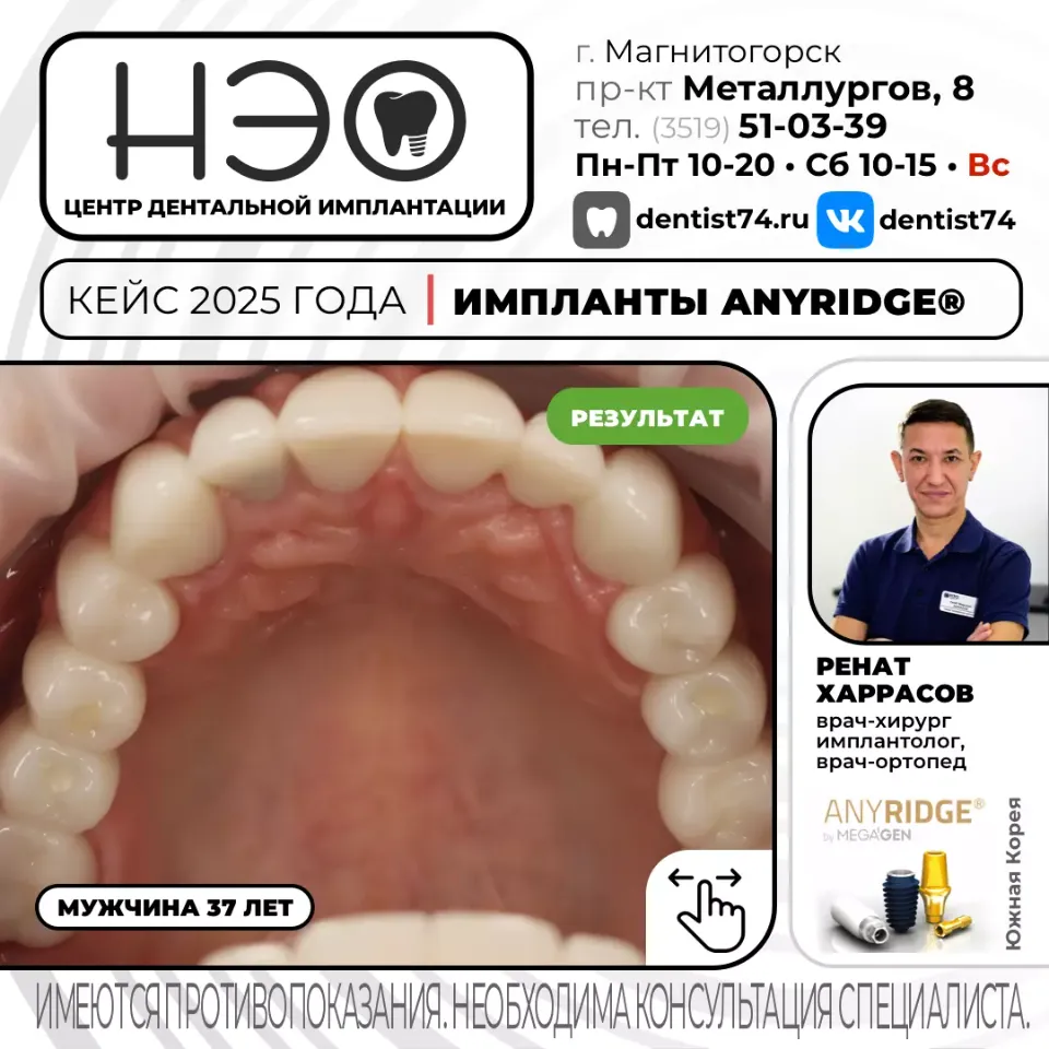 КЕЙС №03/2025 ИМПЛАНТАЦИЯ ЗУБОВ НА ИМПЛАНТАХ ANYRIDGE (Ю.Корея) В МАГНИТОГОРСКЕ. 