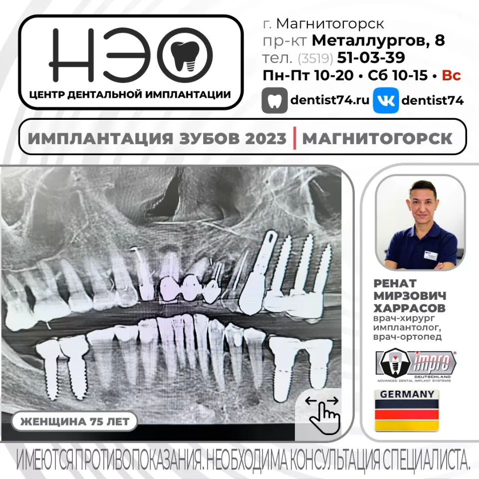 КЕЙС №01/2023 16+ ИМПЛАНТАЦИЯ ЗУБОВ НА ИМПЛАНТАХ IMPRO (Германия) В МАГНИТОГОРСКЕ