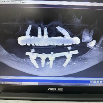 ИМПЛАНТАЦИЯ ПО СИСТЕМЕ ALL-ON-4 В МАГНИТОГОРСКЕ