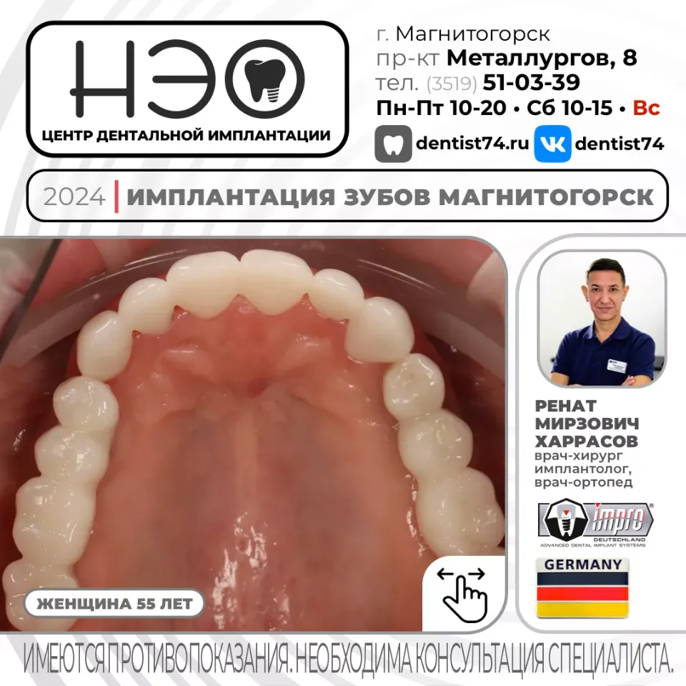 КЕЙС №01/2024 ИМПЛАНТАЦИЯ ЗУБОВ НА ИМПЛАНТАХ IMPRO (ГЕРМАНИЯ) В МАГНИТОГОРСКЕ.