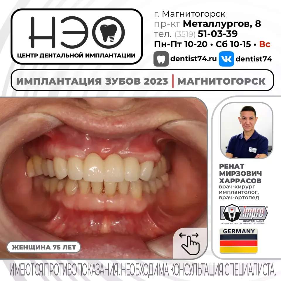 КЕЙС №01/2023 16+ ИМПЛАНТАЦИЯ ЗУБОВ НА ИМПЛАНТАХ IMPRO (Германия) В МАГНИТОГОРСКЕ