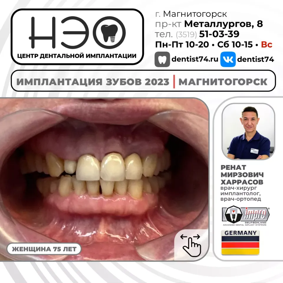 КЕЙС №01/2023 16+ ИМПЛАНТАЦИЯ ЗУБОВ НА ИМПЛАНТАХ IMPRO (Германия) В МАГНИТОГОРСКЕ