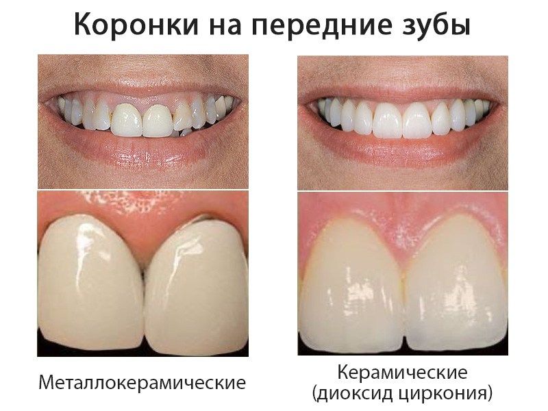 Коронка диоксид циркония а4. Диоксид циркония коронки на передние зубы. Коронка диоксид циркония и металлокерамика. Коронка диоксид циркония на передние 2 зуба.