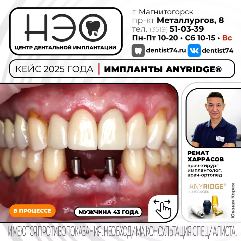 Работы доктора Харрасова Р.М. имплантация зубов в Магнитогорске