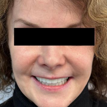 ИМПЛАНТАЦИЯ ПО СИСТЕМЕ ALL-ON-4 В МАГНИТОГОРСКЕ