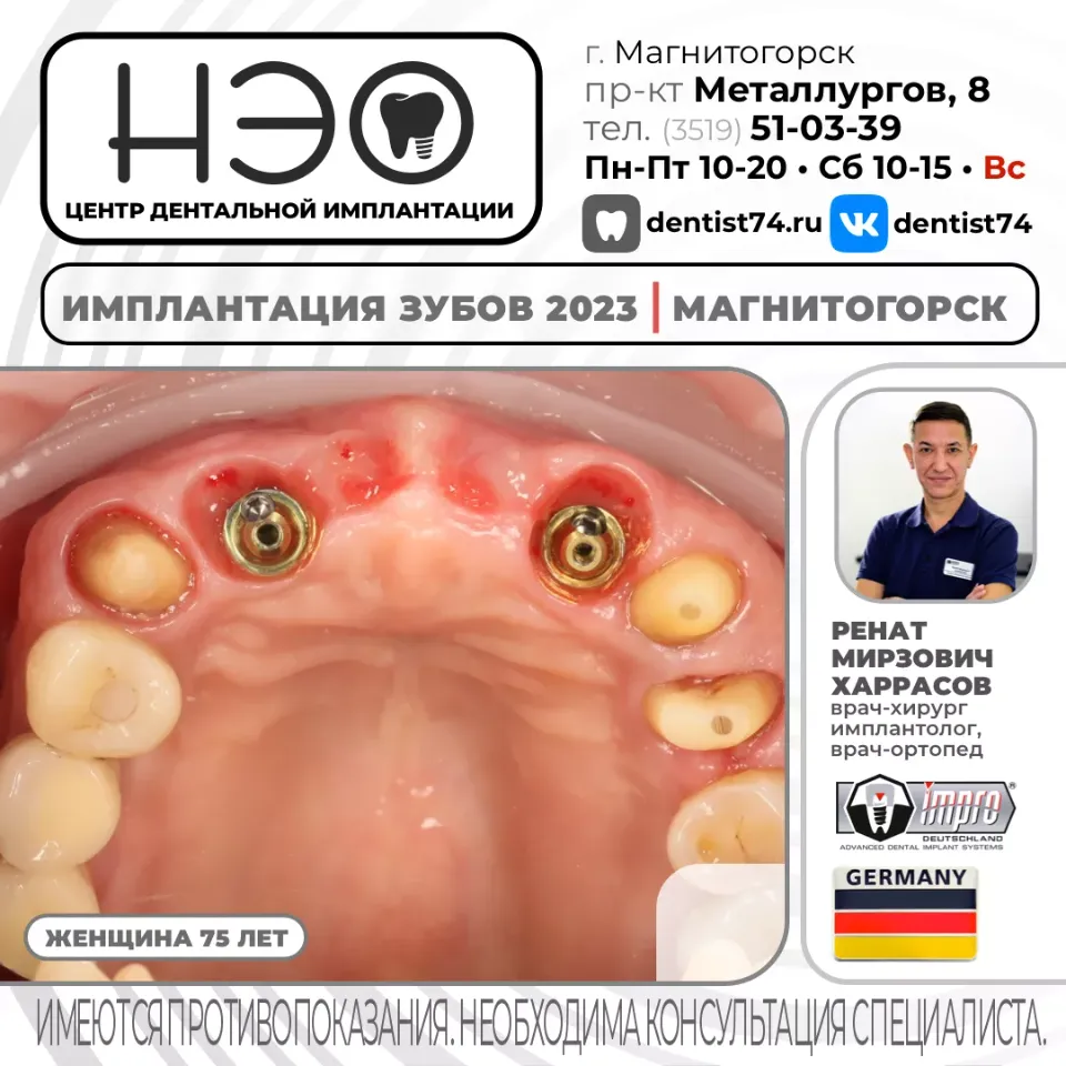 КЕЙС №01/2023 16+ ИМПЛАНТАЦИЯ ЗУБОВ НА ИМПЛАНТАХ IMPRO (Германия) В МАГНИТОГОРСКЕ