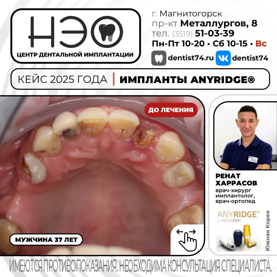 КЕЙС №03/2025 ИМПЛАНТАЦИЯ ЗУБОВ НА ИМПЛАНТАХ ANYRIDGE (Ю.Корея) В МАГНИТОГОРСКЕ. 