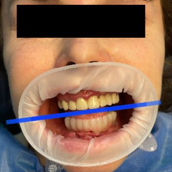 ИМПЛАНТАЦИЯ ПО СИСТЕМЕ ALL-ON-4 В МАГНИТОГОРСКЕ