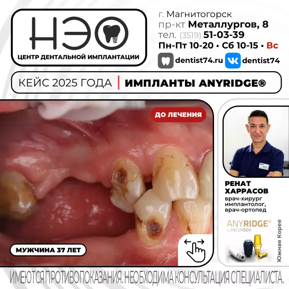 КЕЙС №03/2025 ИМПЛАНТАЦИЯ ЗУБОВ НА ИМПЛАНТАХ ANYRIDGE (Ю.Корея) В МАГНИТОГОРСКЕ. 