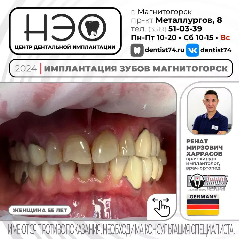 КЕЙС №01/2024 ИМПЛАНТАЦИЯ ЗУБОВ НА ИМПЛАНТАХ IMPRO (ГЕРМАНИЯ) В МАГНИТОГОРСКЕ.