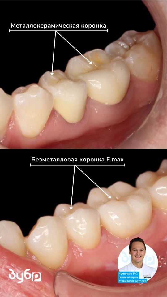 Чумляков ортопед коронки emax и металлокерамика