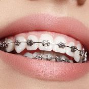 Ортодонтия в стоматологии