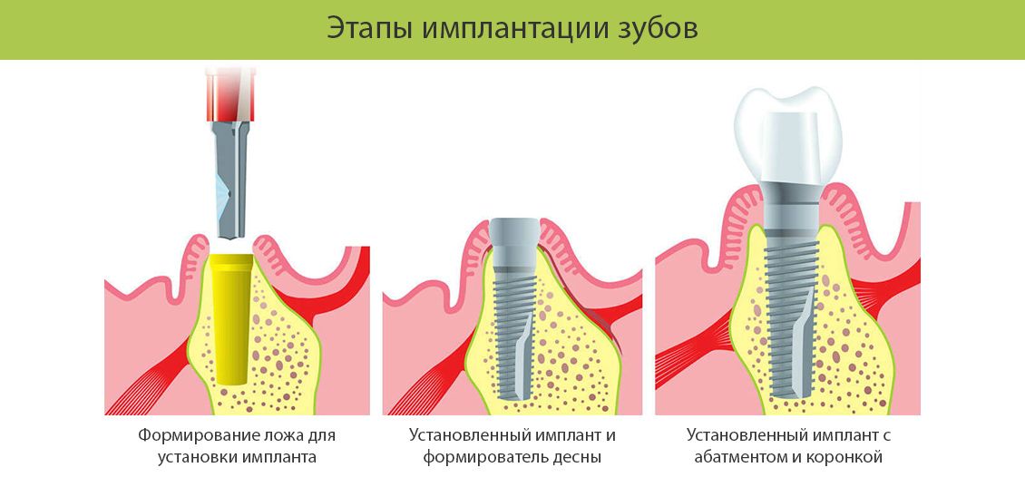 Имплант почему