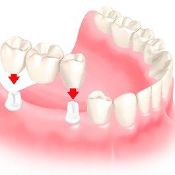 Имплантация зубов