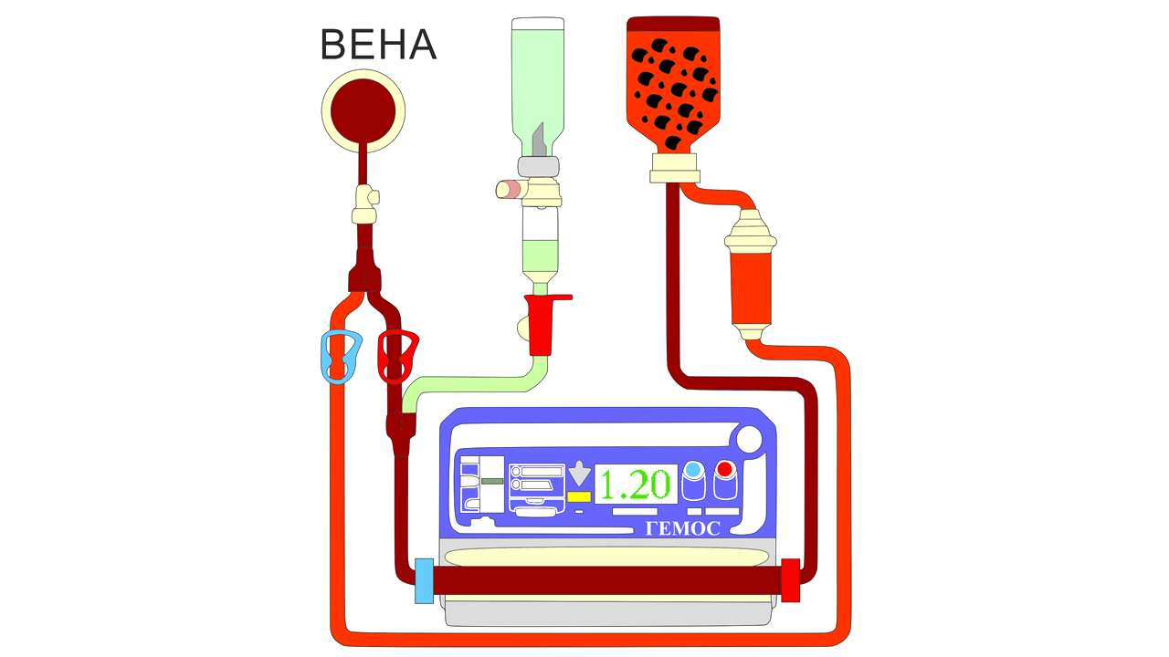 Чистка плазмы. Плазмаферез центрифужный алгоритм. Мембранный плазмаферез. Аппаратный плазмаферез.