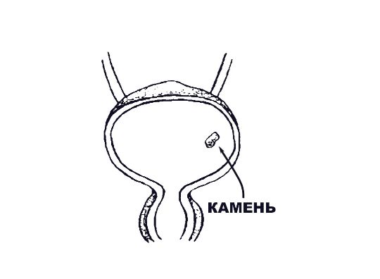 Камень в мочевыделительной системе