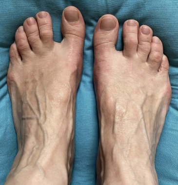 Результат после SCARF остеотомии