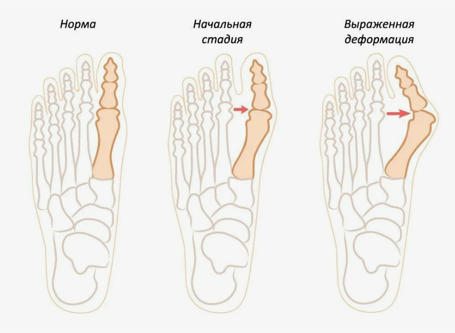 деформации стопы, лечение деформаций стопы, Hallux Valgus, косточки на ногах лечение