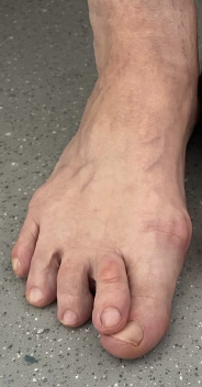 Шишка на стопе, косточки на стопах ног лечение, операции на шишках стоп, операция удаления шишки на стопе, шишка на большом пальце стопы операция, косточка на стопе операция, операция по удалению косточки на стопе, операция на косточке большого пальца стопы, операции стопы косточек на ногах, операция на косточке стопы цена, удаление косточки на стопе название операции, палец наездник, палец наездник на ноге.