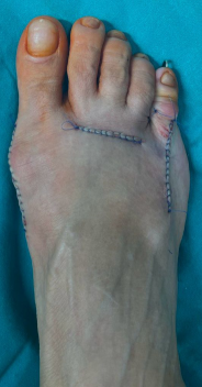 молоткообразные пальцы
молоткообразная деформация пальцев
молоткообразные пальцы стопы
молоткообразная деформация пальцев стопы
молоткообразные пальцы на ногах
лечение молоткообразных пальцев
молоткообразный палец операция
молоткообразная деформация 2 пальца
корректор молоткообразного пальца
молоткообразный 2 палец стопы
молоткообразный второй палец
молоткообразные пальцы на ногах лечение
молоткообразная деформация 2 пальца стопы
молоткообразная деформация пальцев ног
молоткообразные пальцы стопы операция
лечение молоткообразной деформации пальцев
молоткообразная деформация пальцев операция
молоткообразные пальцы причина
молоткообразный палец фото
лечение молоткообразного пальца стопы