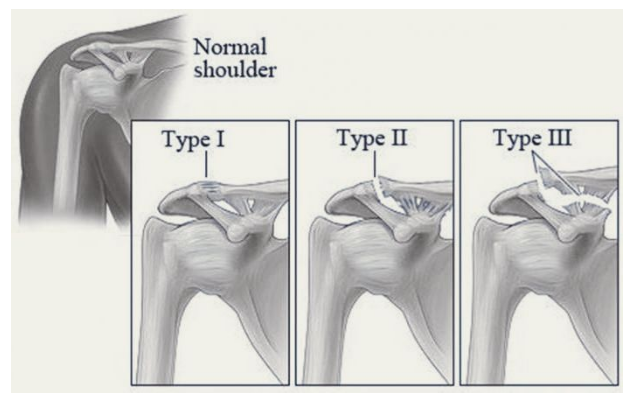 разрыв связок акромиально-ключичного сочленения плечевого сустава лечение операция
